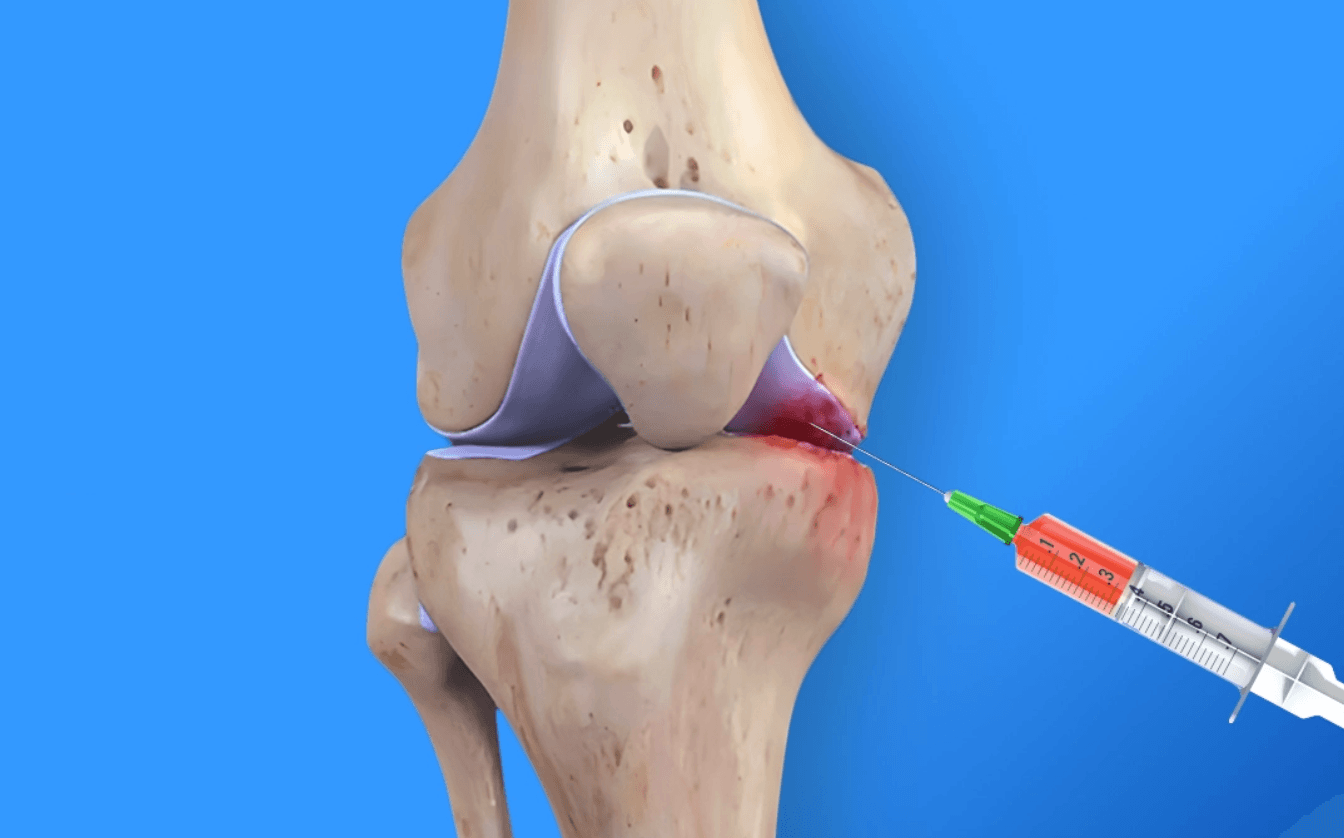 Артроз 1-2 стадії: як зупинити руйнування суглоба за допомогою регенеративної медицини?