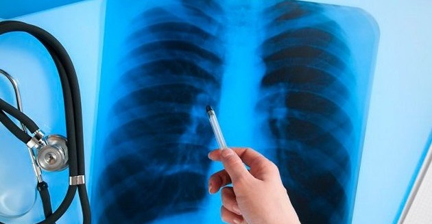 В "ДНР" продолжает распространяться туберкулез