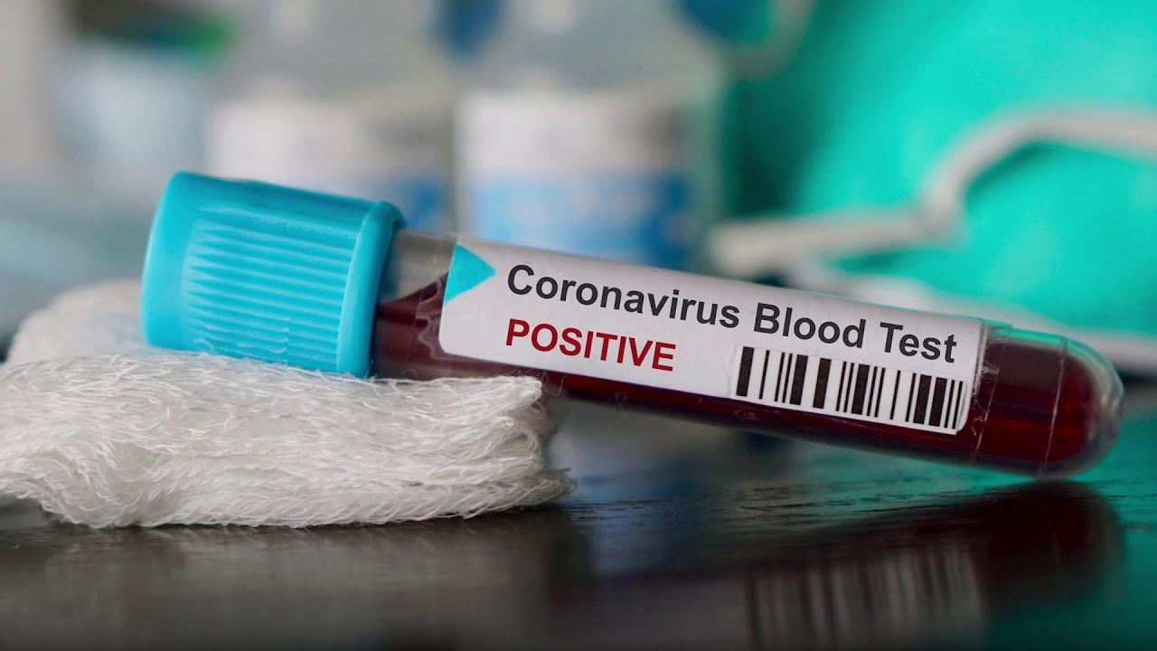 В Украине зафиксировано 8125 случаев коронавирусной болезни COVID-19