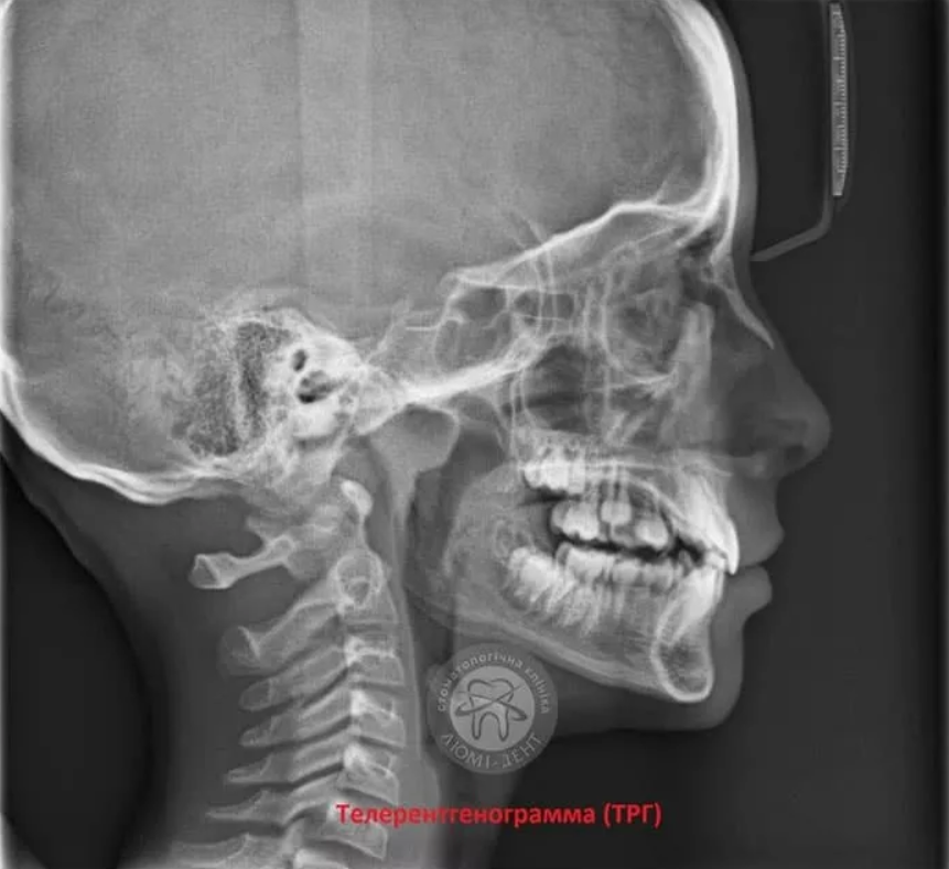 телерентгенограмма в Люмидент