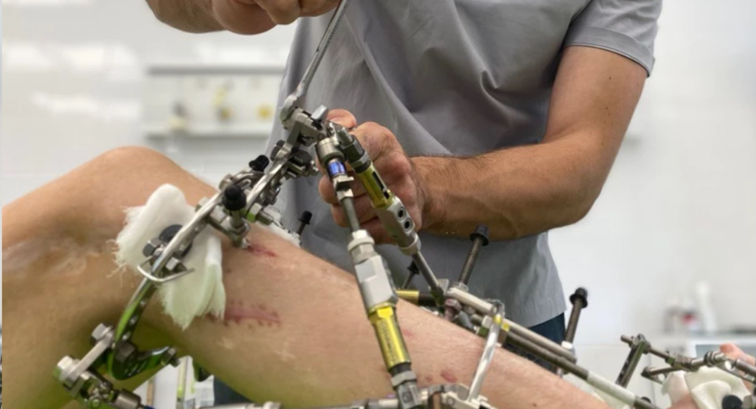 У Лимані на базі обласної травматології створять унікальний центр лікування деформації кінцівок
